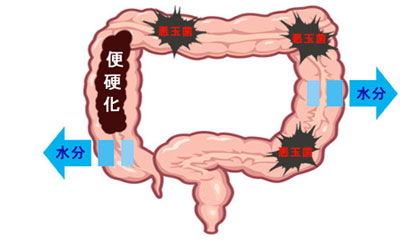 便秘と毒素の関係