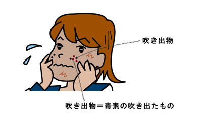 便秘によりスムーズに出ていかない毒素は吹き出物として排出