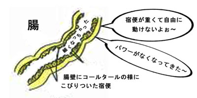 便秘の第一の理由コールタール状になった宿便