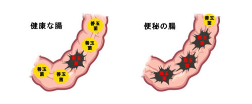 便秘の第二の理由悪玉菌の増加
